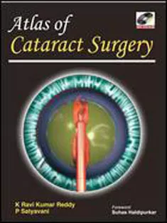 Atlas Of Cataract Surgery