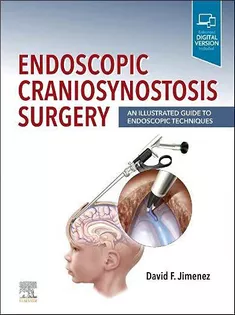 Endoscopic Craniosynostosis Surgery