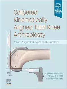 Calipered Kinematically Aligned Total Knee Arthroplasty