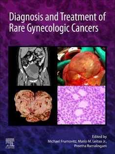 Diagnosis and Treatment of Rare Gynecologic Cancers