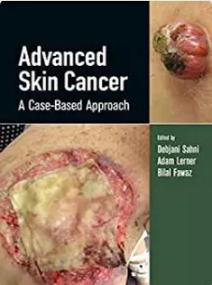 Advanced Skin Cancer: A Case-Based Approach