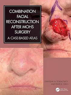 Combination Facial Reconstruction After Mohs Surgery