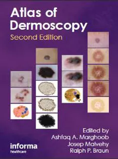 An Atlas of Dermoscopy