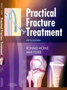 Practical Fracture Treatment