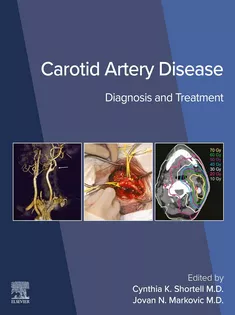 Carotid Artery Disease