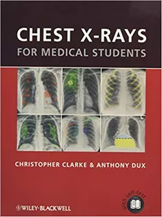 Chest X-rays for Medical Students