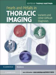 Pearls and Pitfalls in Thoracic Imaging: Variants and Other Difficult Diagnoses
