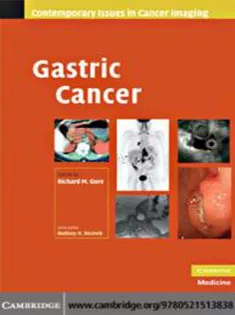 Gastric Cancer