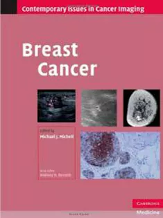 Breast Cancer