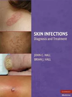Skin Infections: Diagnosis and Treatment