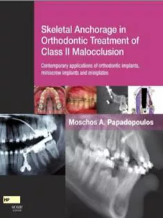 Skeletal Anchorage in Orthodontic Treatment of Class II Malocclusion