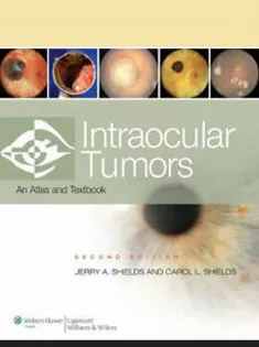 Intraocular Tumors: Atlas and Text