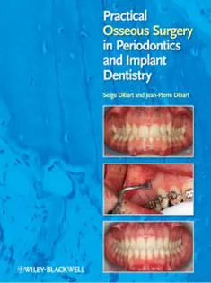 Practical Osseous Surgery in Periodontics and Implant