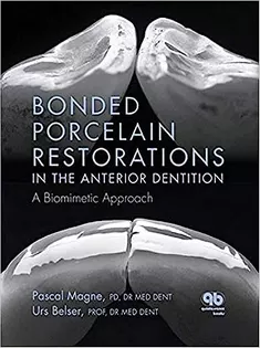 Bonded Porcelain Restorations in the Anterior Dentition