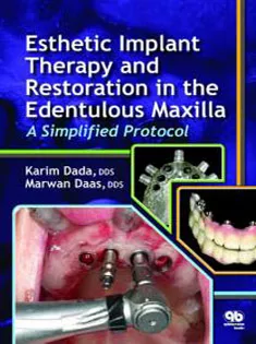 Esthetic Implant Restoration in the Edentulous Maxilla: A Simplified Protocol