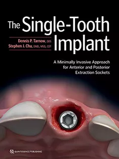 The Single-Tooth Implant