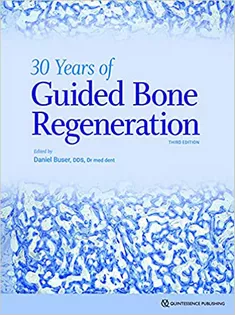 30 Years of Guided Bone Regeneration in Implant Dentistry
