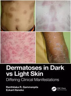 Dermatoses in Dark Vs Light Skin Differing Clinical Manifestations