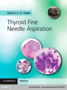 Thyroid Fine Needle Aspiration