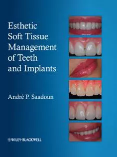 Esthetic Soft Tissue Management of Teeth and Implants