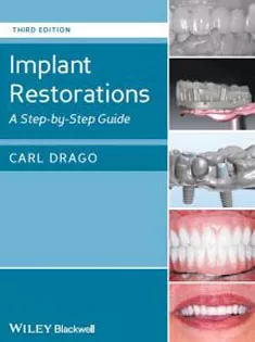 Implant Restorations: A Step-by-Step Guide2014