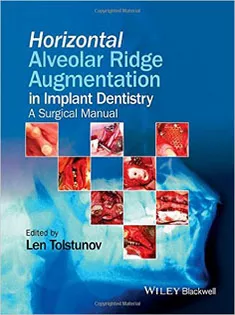 Horizontal Alveolar Ridge Augmentation in Implant Dentistry