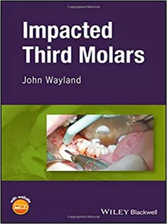 Impacted Third Molars