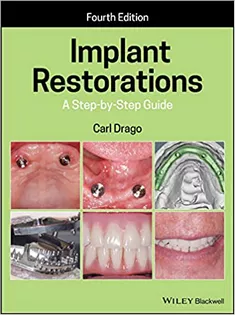 Implant Restorations: A Step-by-Step Guide
