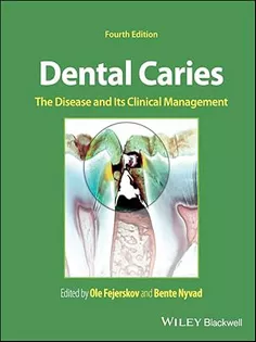 Dental Caries: The Disease and Its Clinical Management