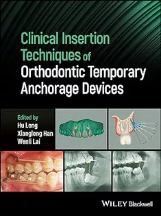 Clinical Insertion Techniques of Orthodontic Temporary Anchorage Devices