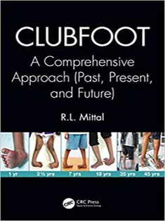 Clubfoot: A Comprehensive Approach