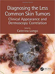Diagnosing the Less Common Skin Tumors