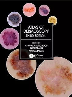 Atlas of Dermoscopy: Third Edition