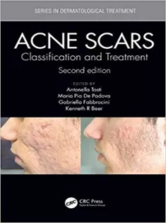 9781138894228 Acne Scars: Classification and Treatment