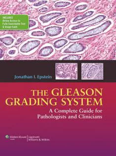 The Gleason Grading System: A Complete Guide for Pathologist and Clinicians