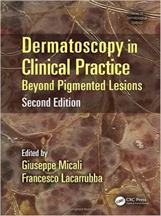Dermatoscopy in Clinical Practice: Beyond Pigmented Lesions