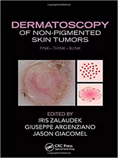 Dermatoscopy of Non-Pigmented Skin Tumors