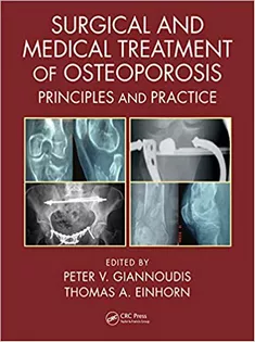9781498732246 Surgical and Medical Treatment of Osteoporosis