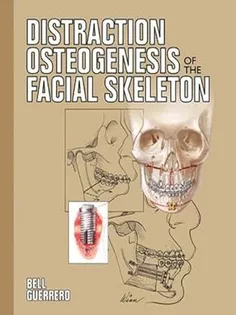 Distraction Osteogenesis of The Facial Skeleton