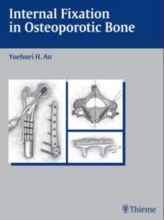 Internal Fixation in Osteoporotic Bone