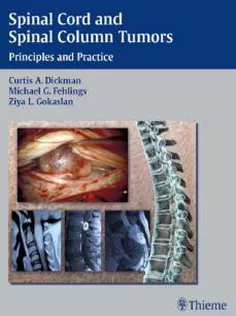 Spinal Cord and Spinal Column Tumors