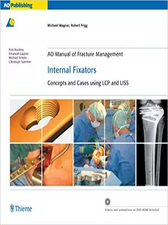 AO Manual of Fracture Management - Internal Fixators