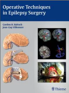Operative Techniques In Epilepsy Surgery