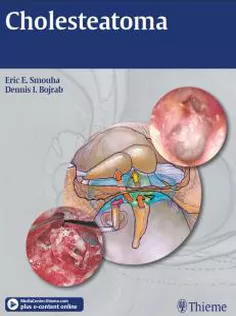 Cholesteatoma