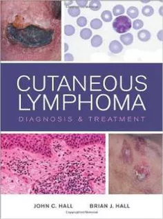 Cutaneous Lymphoma: Diagnosis and Treatment