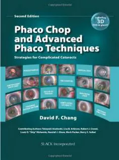 Phaco Chop and Advanced PhacoTechniques