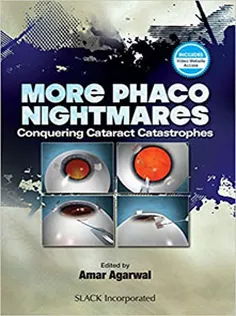 More Phaco Nightmares Conquering Cataract Catastrophes