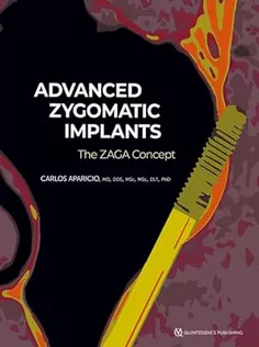 Advanced Zygomatic Implants: The Zaga Concept