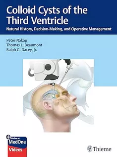 Colloid Cysts of the Third Ventricle: Natural History, Decision-Making, and Operative Management
