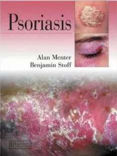 Psoriasis